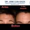 Botox/Dysport - Eliminar arrugas