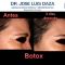 Botox/Dysport - Eliminar arrugas