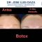 Botox/Dysport - Eliminar arrugas