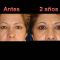Cirugía de párpados (Blefaroplastia)