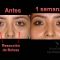 Cirugía de párpados (Blefaroplastia)