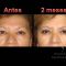Cirugía de párpados (Blefaroplastia)