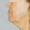 Facelift