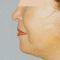 Facelift