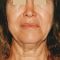 Facelift