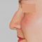 Plastika nosu (Rhinoplastika)