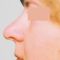 Plastika nosu (Rhinoplastika)