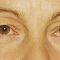 Eyelid surgery (Blepharoplasty)