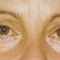 Eyelid surgery (Blepharoplasty)