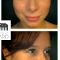 Rhinoplastie