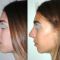 Rhinoplastie