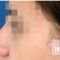 Nasenkorrektur - Rhinoplastik
