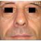 Injections de comblement