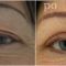 Operácia očných viečok (Blepharoplastika)