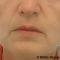 Facelift (operace obličeje), SMAS lifting