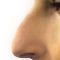 Rhinoplasty (Nose Job)