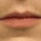 Lip augmentation - cheiloplasty