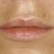 Lip augmentation - cheiloplasty