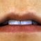 Lip augmentation - cheiloplasty