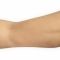 Arm Lift Surgery