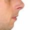 Chin Surgery