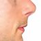 Chin Surgery