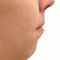 Chin Surgery