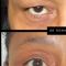 Blépharoplastie