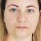 Operácia očných viečok (Blepharoplastika)