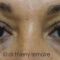 Lipofilling du visage