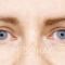 Operácia očných viečok (Blepharoplastika)