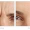 Botulinum toxin - Wrinkle Removal