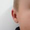 Otoplastie (Chirurgie esthétique des oreilles)