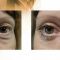 Eyelid surgery (Blepharoplasty)