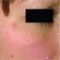 Laser Scar Treatment