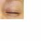 Eyelid surgery (Blepharoplasty)
