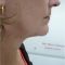 Lifting non chirurgico (Exilis)