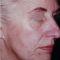 Lifting du visage
