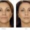 Hyaluronic acid-based wrinkle fillers