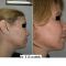 Chirurgie du double-menton