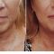 Frakční laserový resurfacing