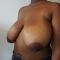 Breast reduction
