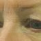 Operácia očných viečok (Blepharoplastika)