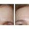 Botulinum toxin - Wrinkle Removal