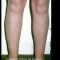 Liposuccion