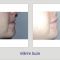 Hyaluronic acid-based wrinkle fillers