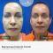 Rejuvenecimiento facial con láser fraccionado