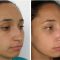 Cirugía de la nariz (Rinoplastia)