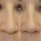 Rinoplastika (operacija nosa)