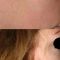 Operácia nosa (Rhinoplastika)
